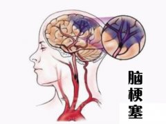 養(yǎng)成好的生活習(xí)慣，能夠有效預(yù)防腦梗塞